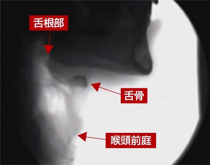 舌骨上筋群への電気刺激の適用による舌骨の動きの変化(ESP実施中)