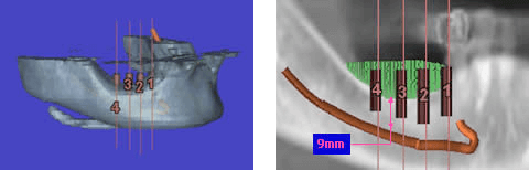 Simplantsによる診断3D画像