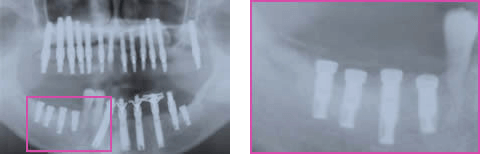 下顎右側臼歯部 再GBR後 6M.1w