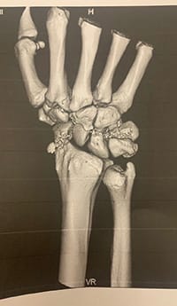 ［手術前のCT画像］手根骨に転位が見られる